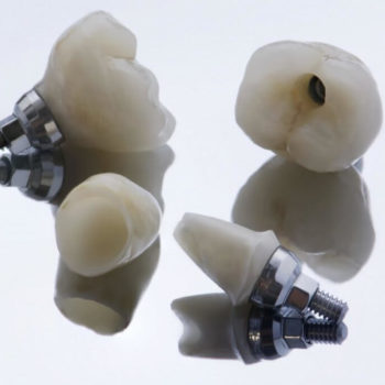 Implant Dentist Canberra | The Dental Surgery In Belconnen