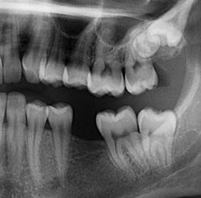 Digital X-Rays Canberra Belconnen | The Dental Surgery In Belconnen