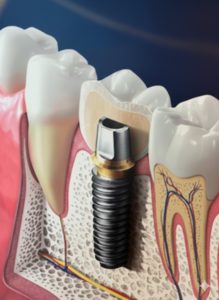 Dental Implants Canberra Belconnen